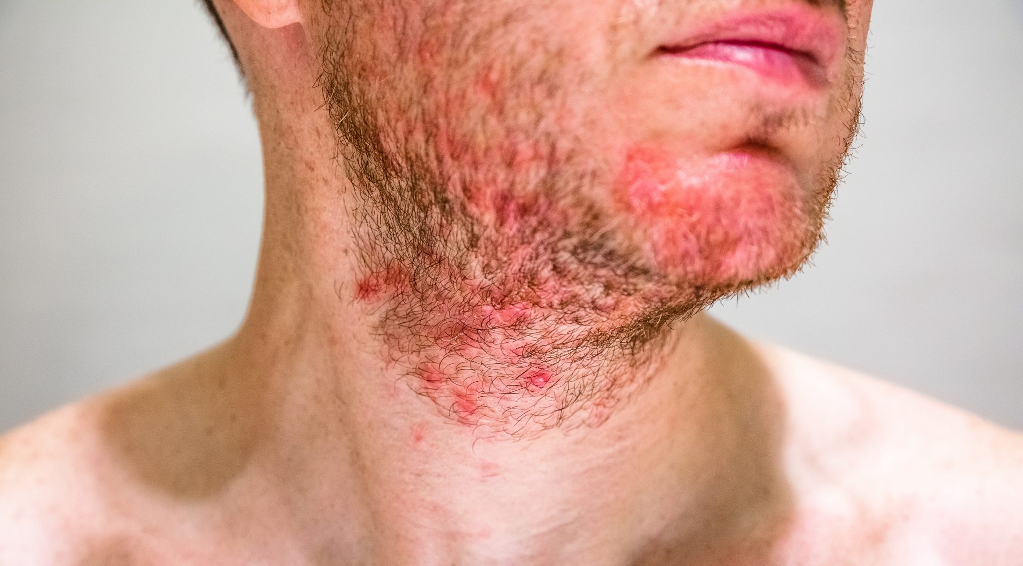 itchy-beard-what-causes-it-and-how-to-stop-it-hair-world-magazine